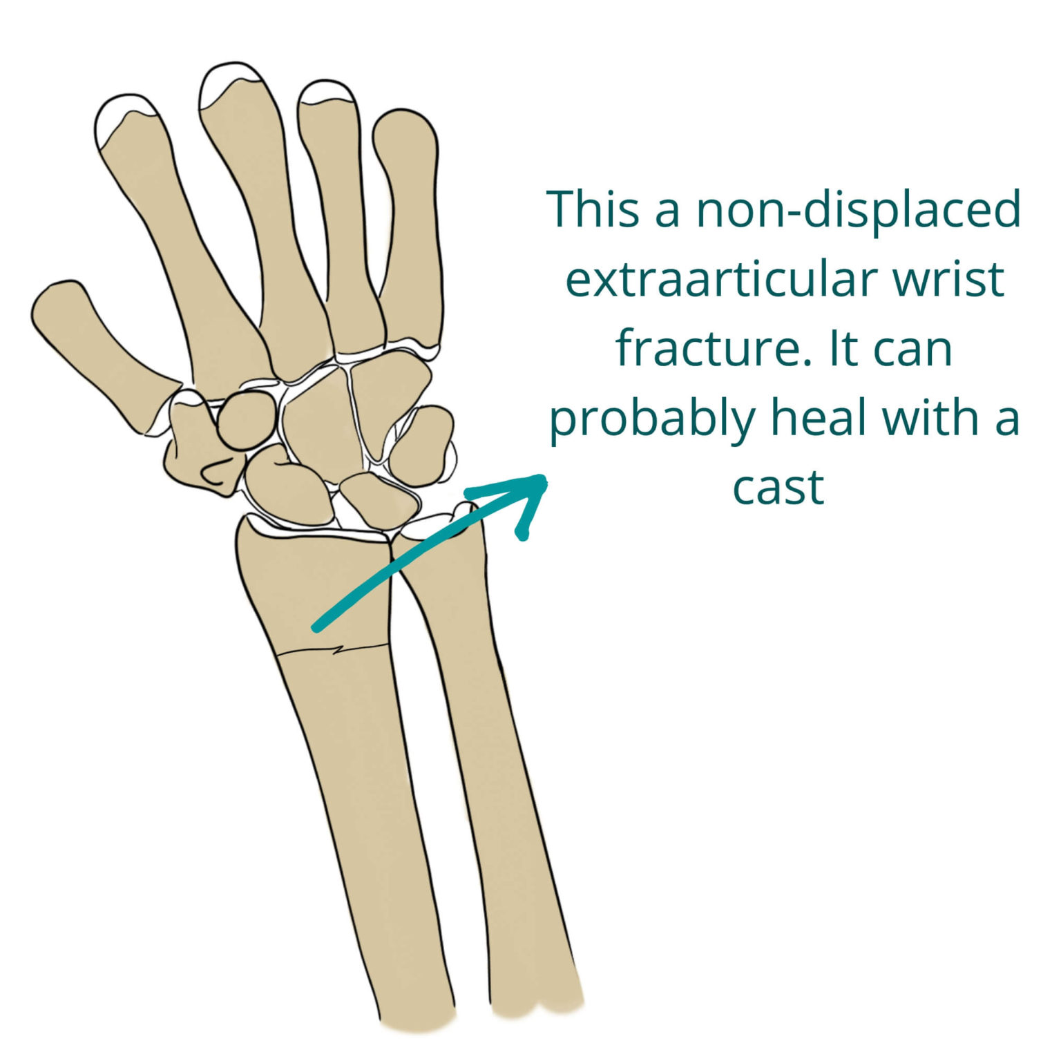 wrist-fractures-distal-radius-fractures-pro-doctor