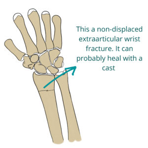 Non-displaced extraarticular wrist fracture