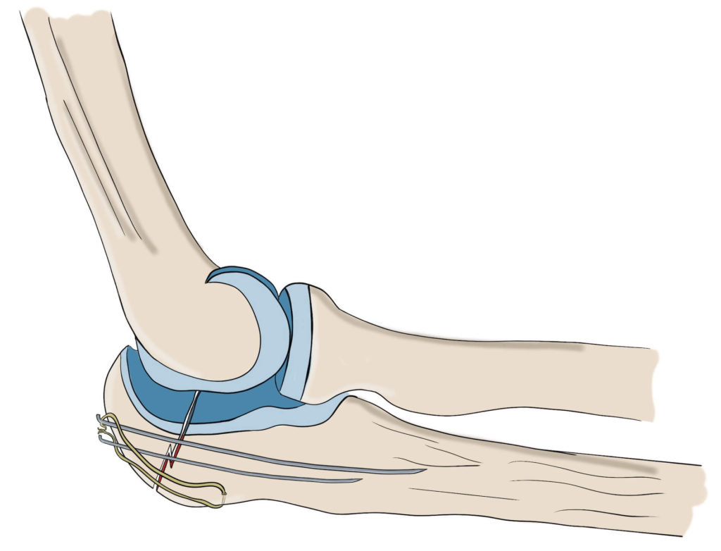 Elbow fracture with broken olecranon treated with tension band wiring