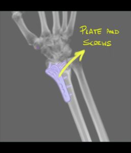 Plate and screws for a radius fracture