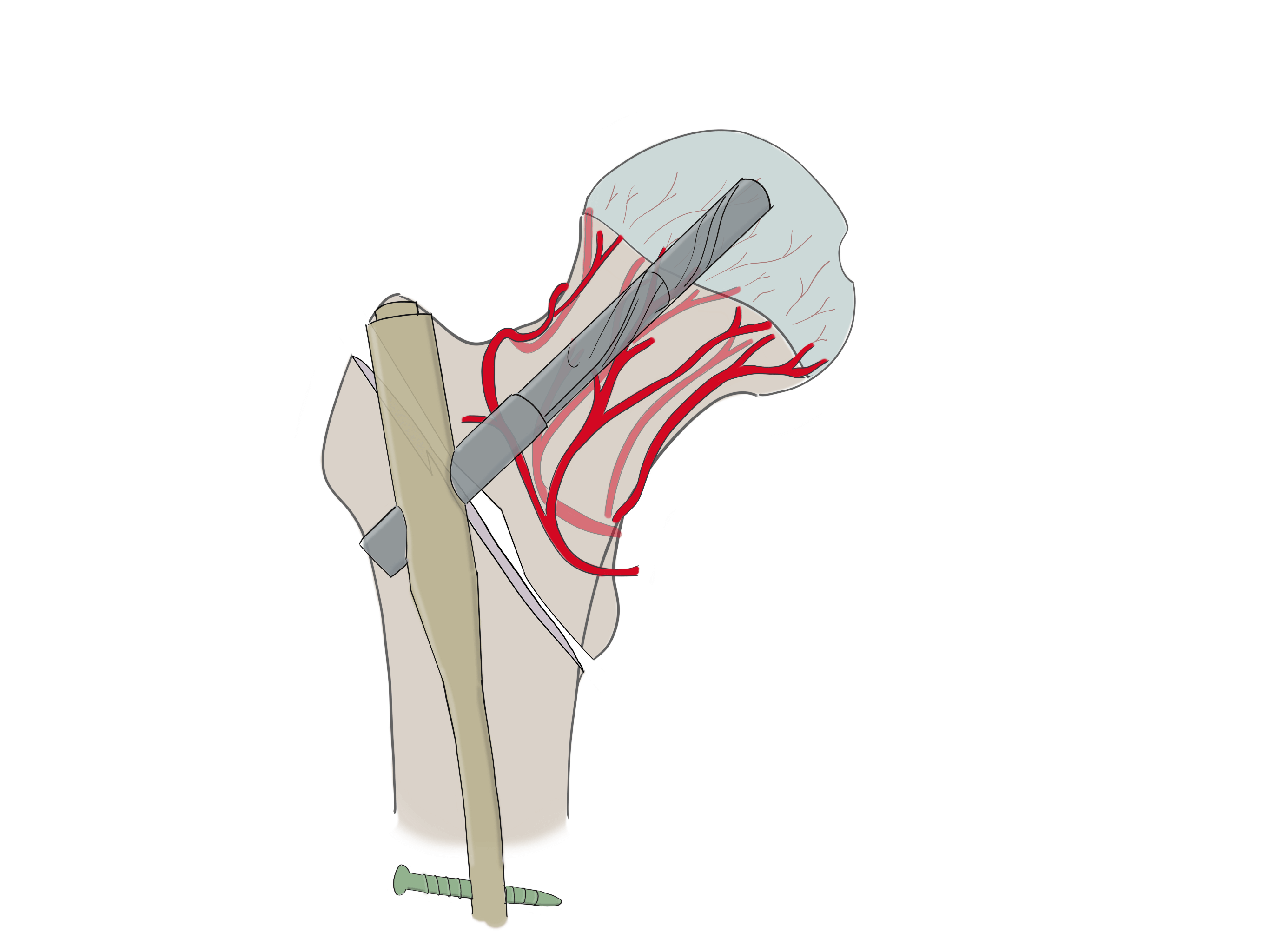 Femoral nail for extracapsular hip fracture