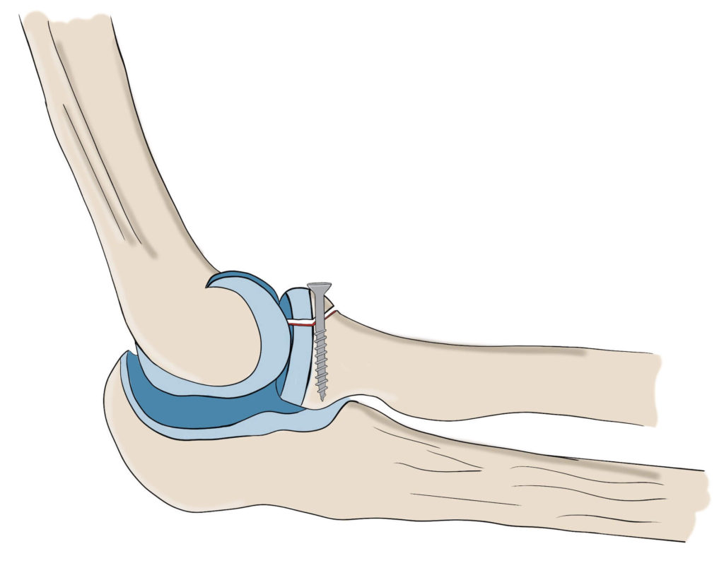 Radial head fracture treatment