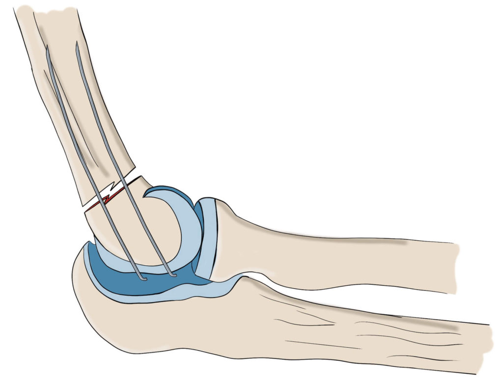 Supracondylar elbow fracture treated with k-wires