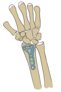 Open reduction and internal fixation (ORIF) with plate