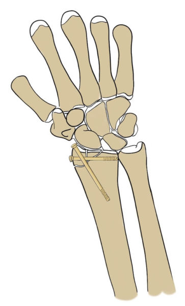 Screws for radial styloid process fracture
