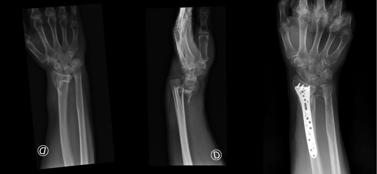 Wrist fracture treated with a plate