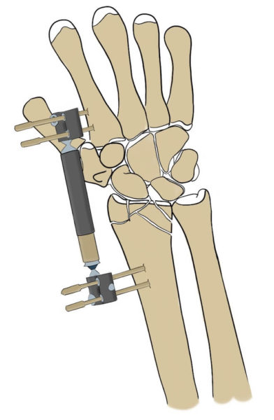 External fixation for the wrist