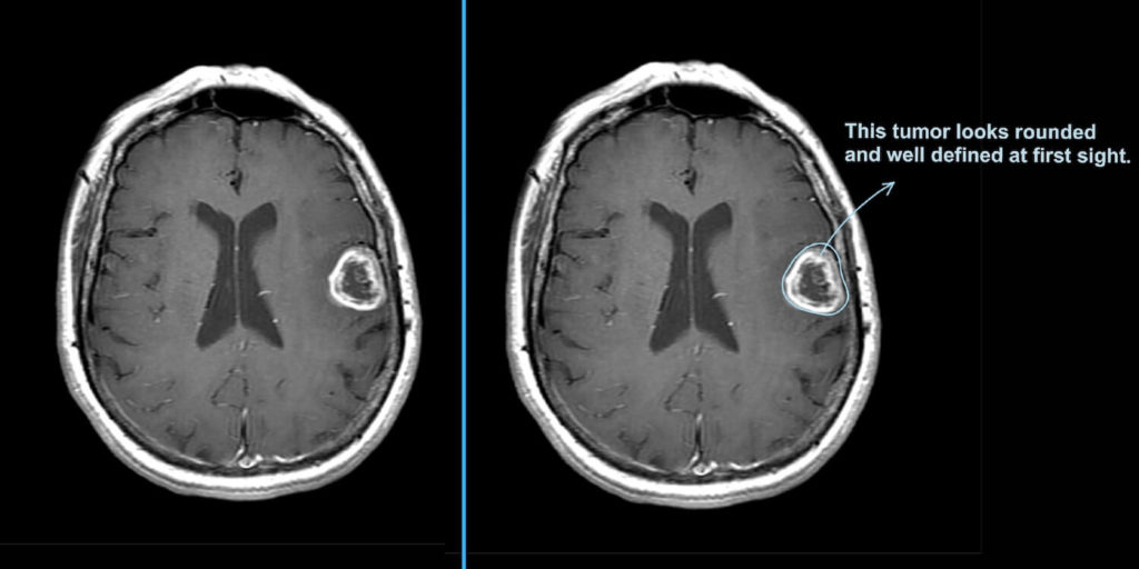 Glioblastoma multiforme on MRI