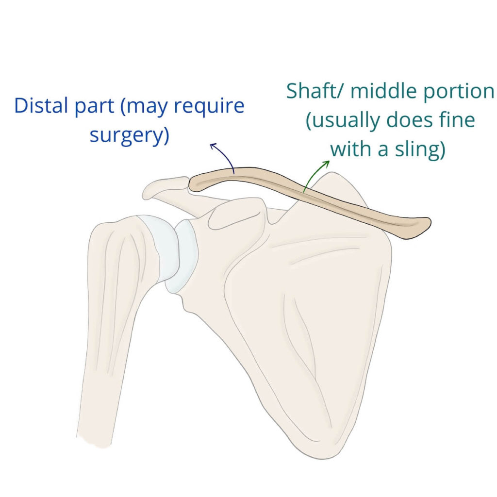 Clavicle parts