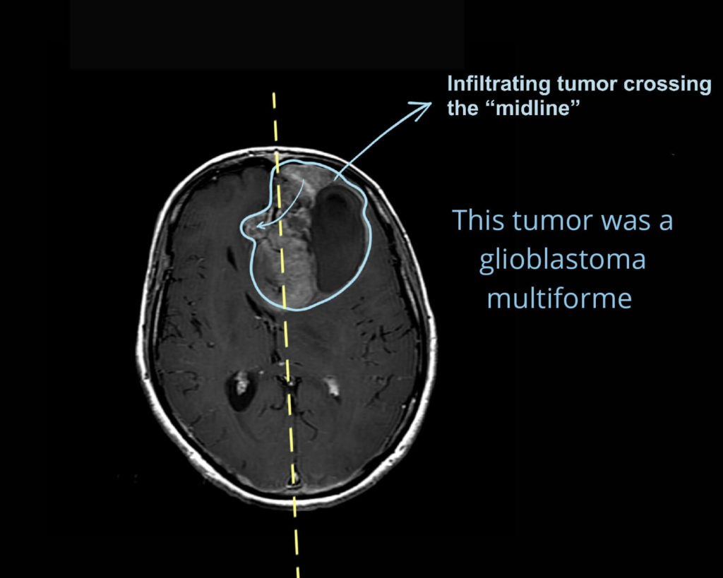 Glioblastoma multiforme infiltrating and crossing midline