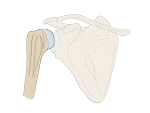 GIF - humeral comminuted fracture treated with arthroplasty