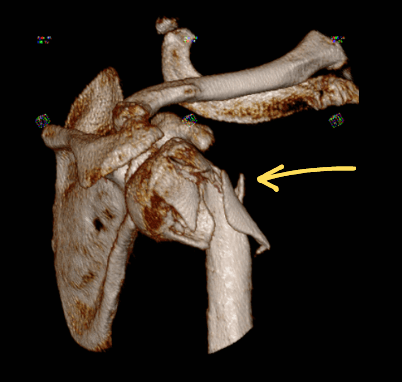 Humeral head fracture.