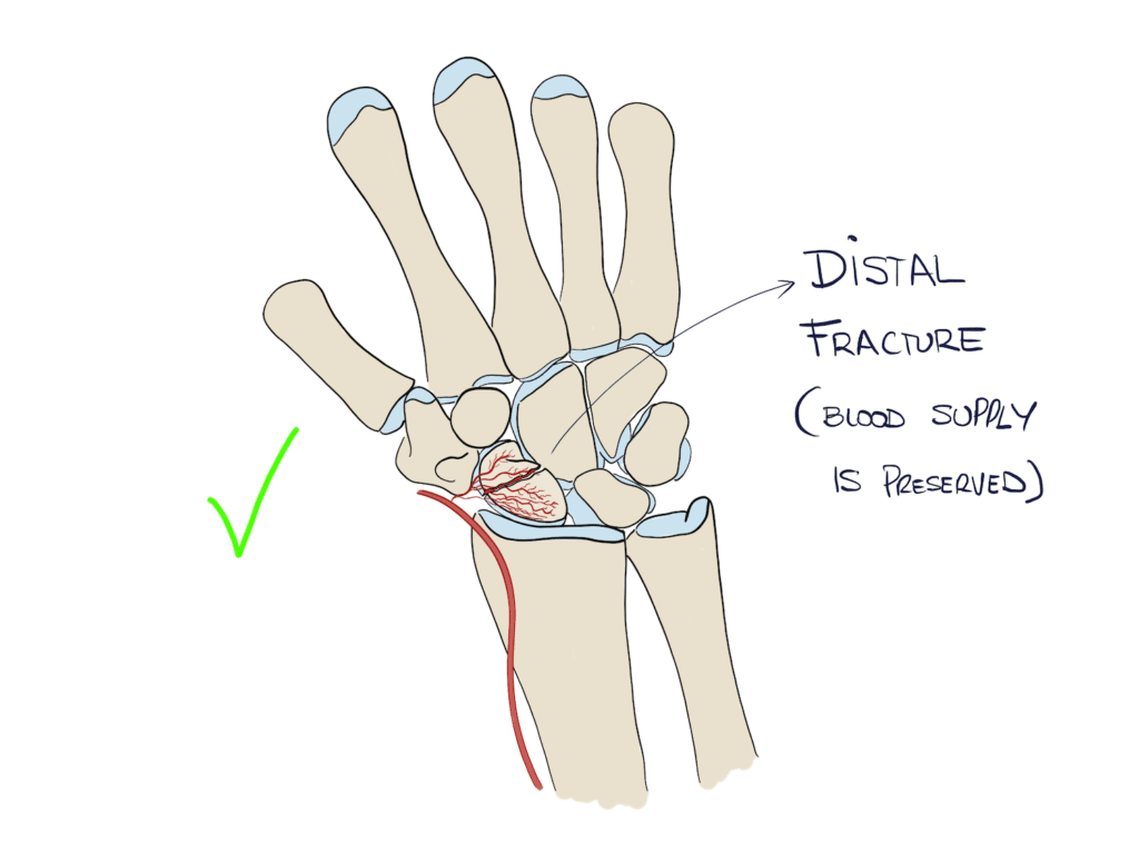 Scaphoid fracture of the distal pole with no complications