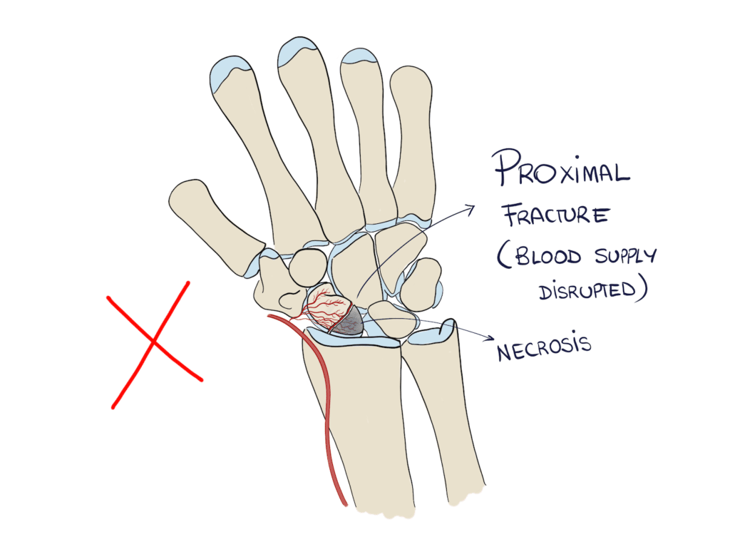 Scaphoid fracture of the proximal pole causing necrosis