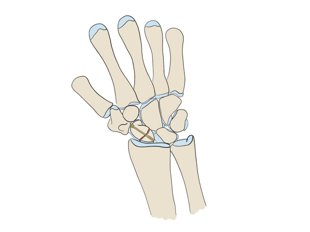 Scaphoid fracture treated with a screw