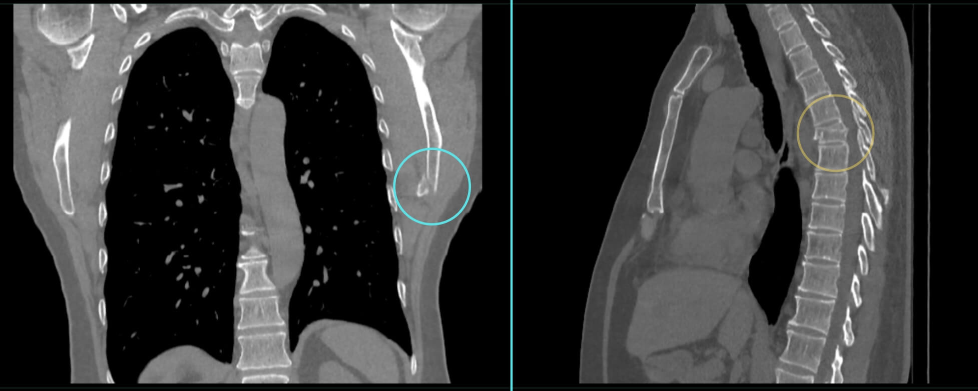 Scapular fracture and vertebral fracture