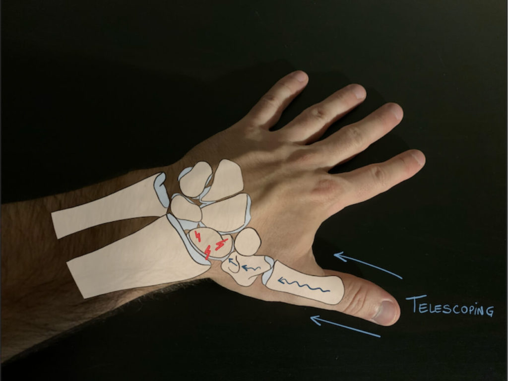 Telescoping technique for scaphoid fractures