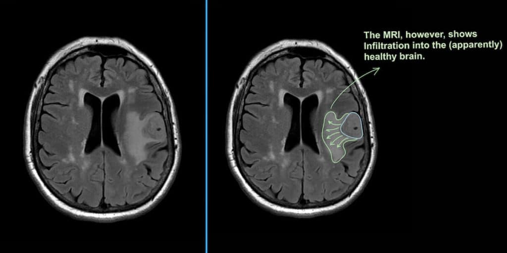 Glioblastoma multiforme real infiltration on MRI