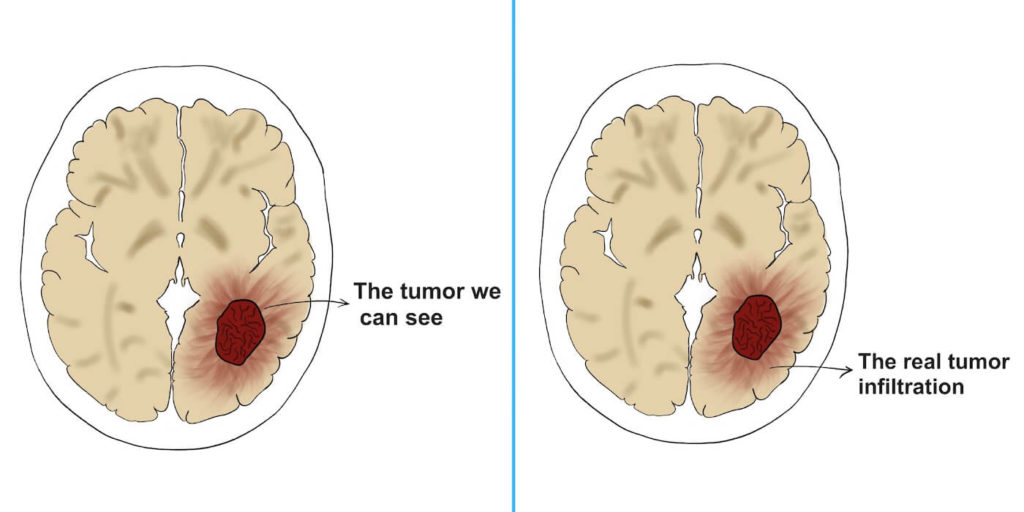 Tumor vs. tumor infiltration