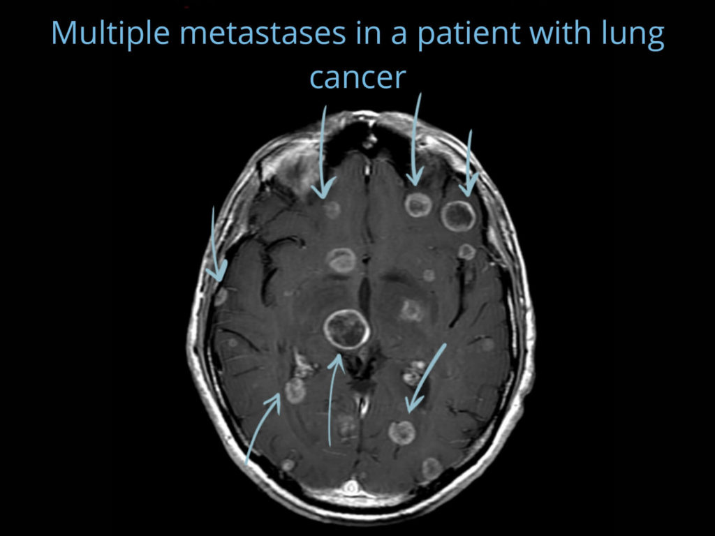 Brain metastases from lung cancer