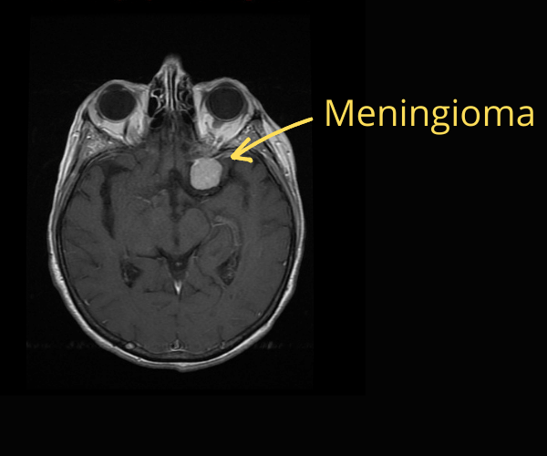 Meningioma on MRI