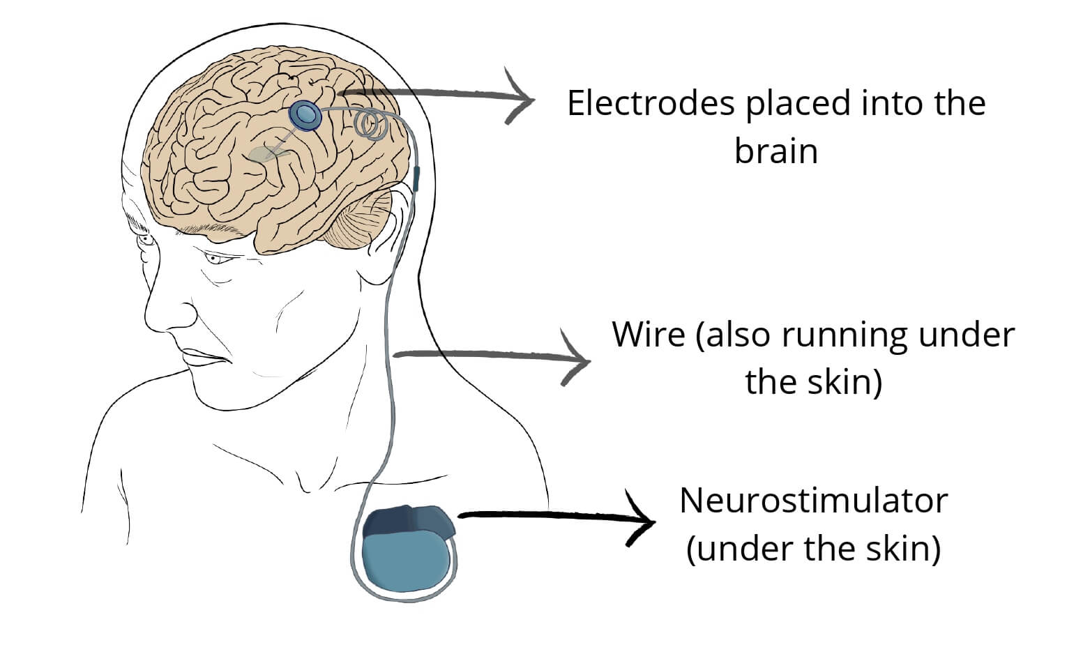 Deep brain stimulation for Parkinson's Disease