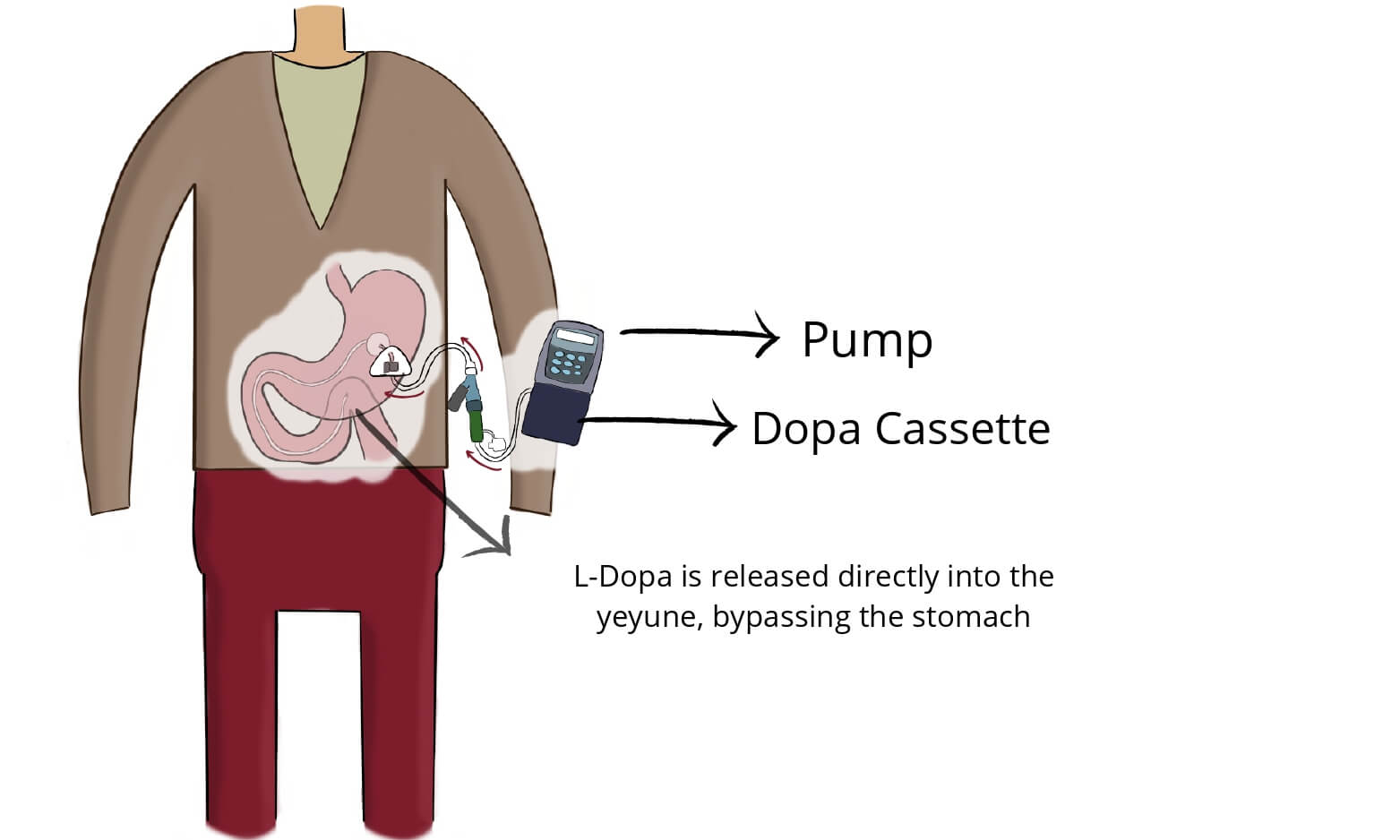 Drawing of L-dopa infusion pump for Parkinson's Disease patients