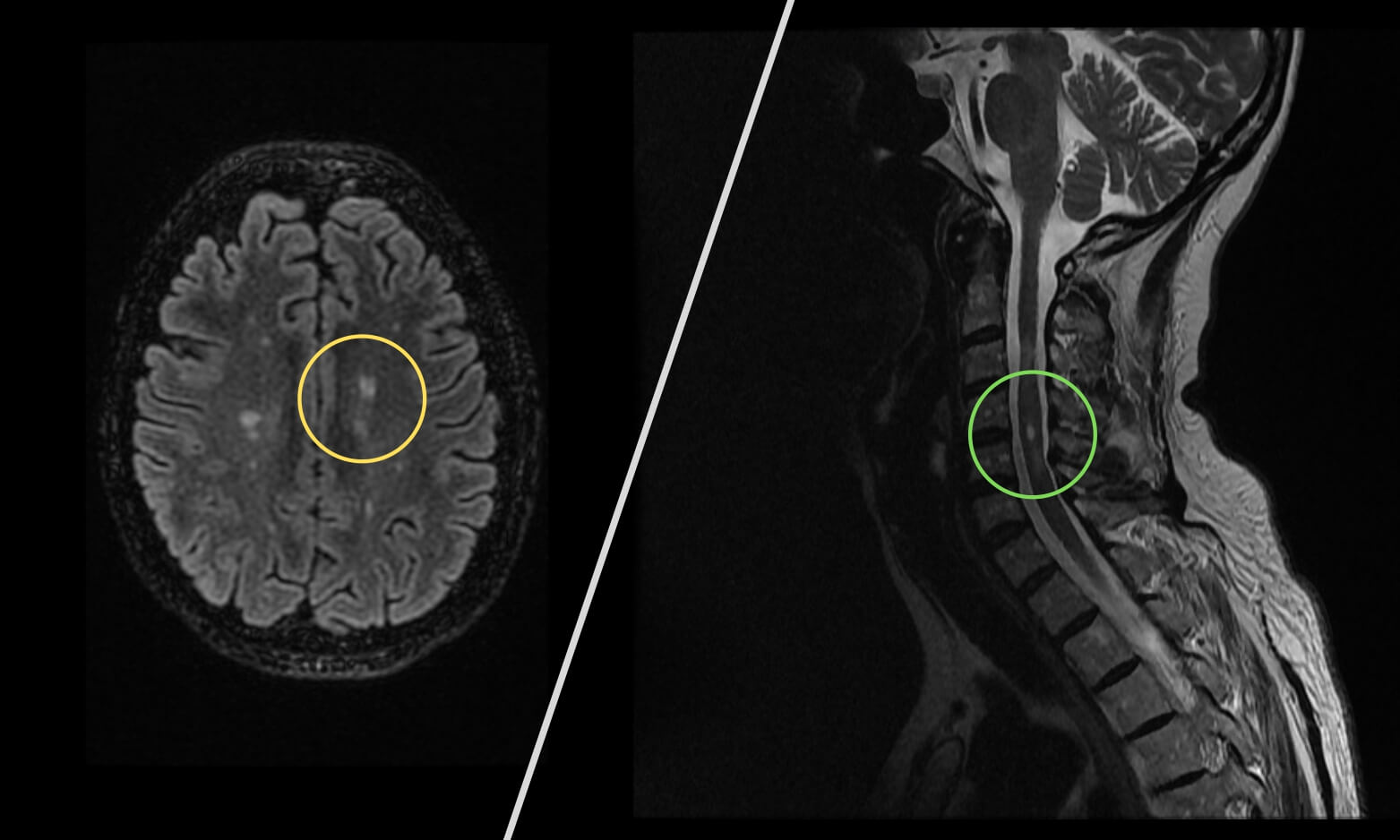 Brain and spine MRI with MS lesions