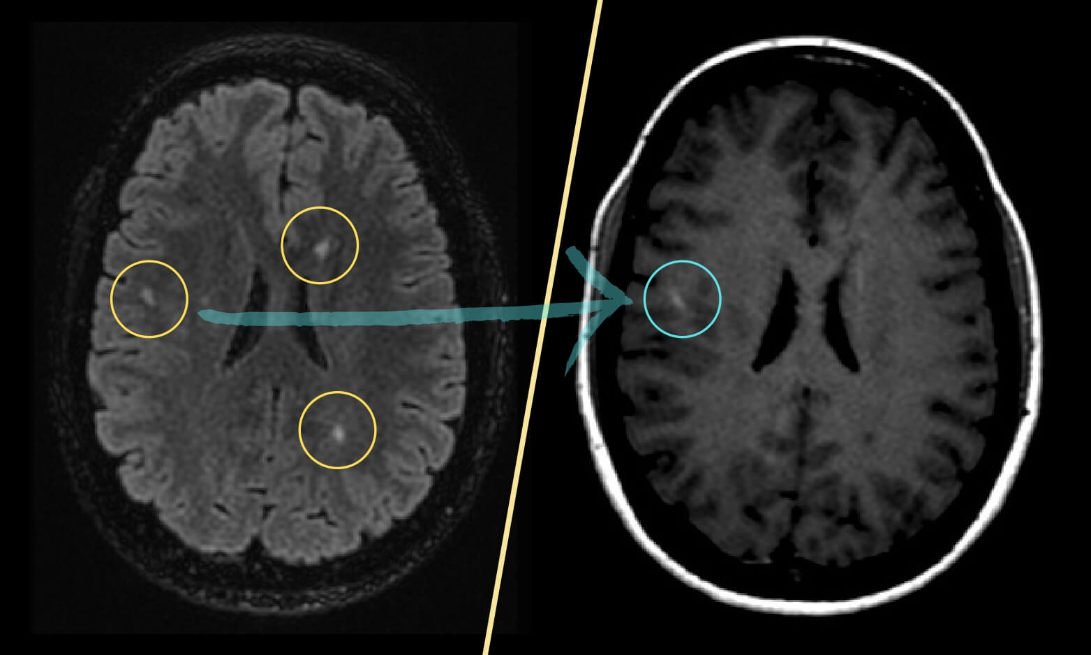 Brain MRI with Multiple Sclerosis lesions showing dissemination in time
