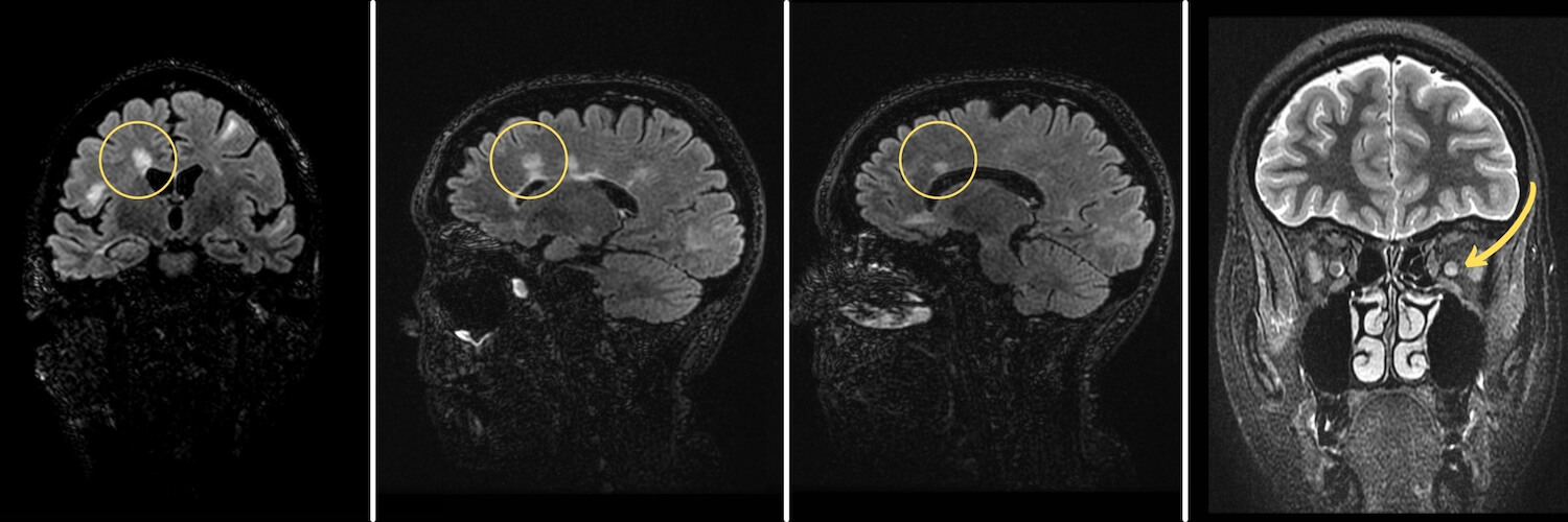MRI of the brain with Multiple Sclerosis lesions: periventricular lesions, lesion in the corpus callosum and optic neuritis