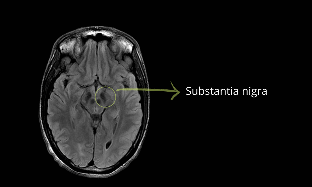 Substantia nigra in brain MRI