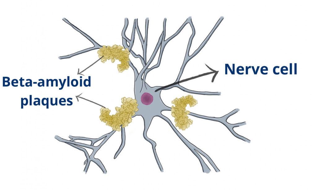 Beta-amyloid plaques on a nerve cell