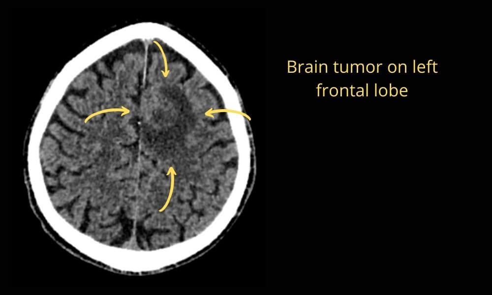 Brain-tumor-on-left-frontal-lobe