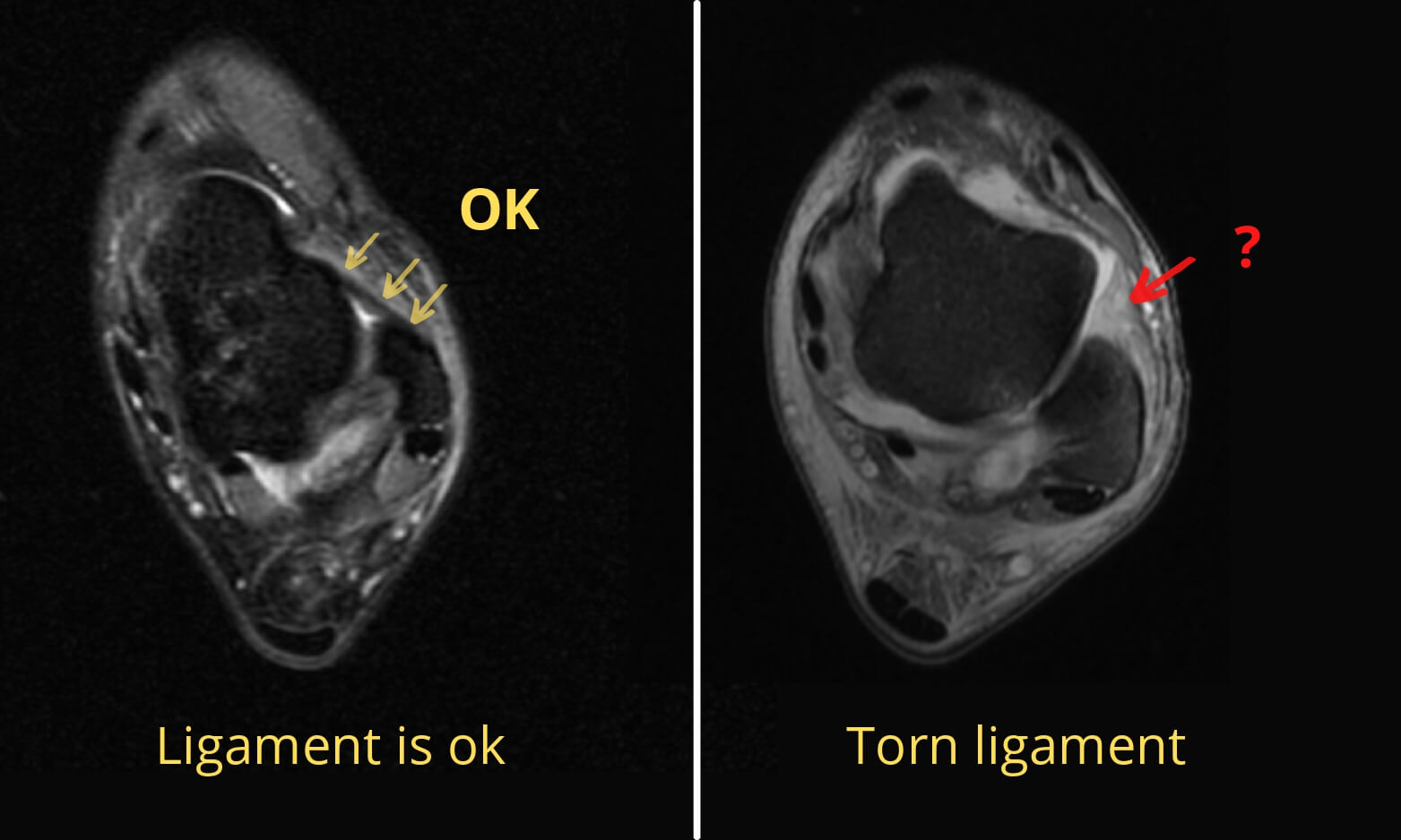 Sprained ankle MRI.