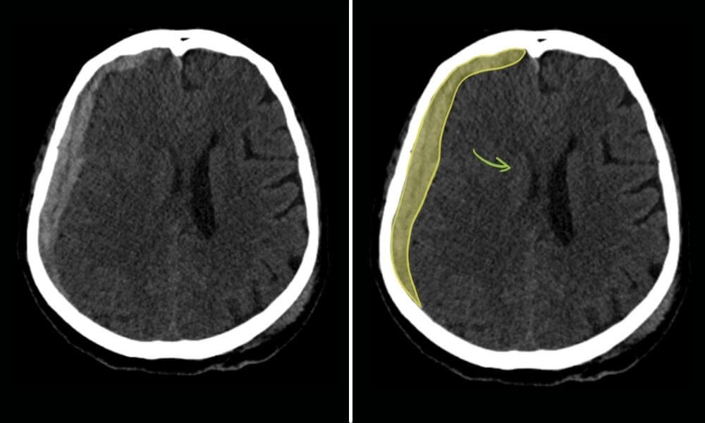 Subdural hematoma