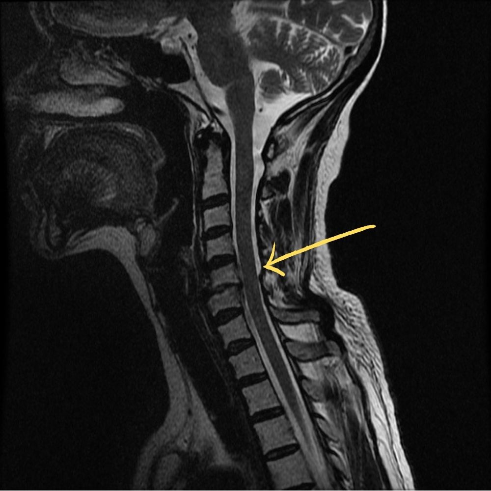 Cervical spine MRI