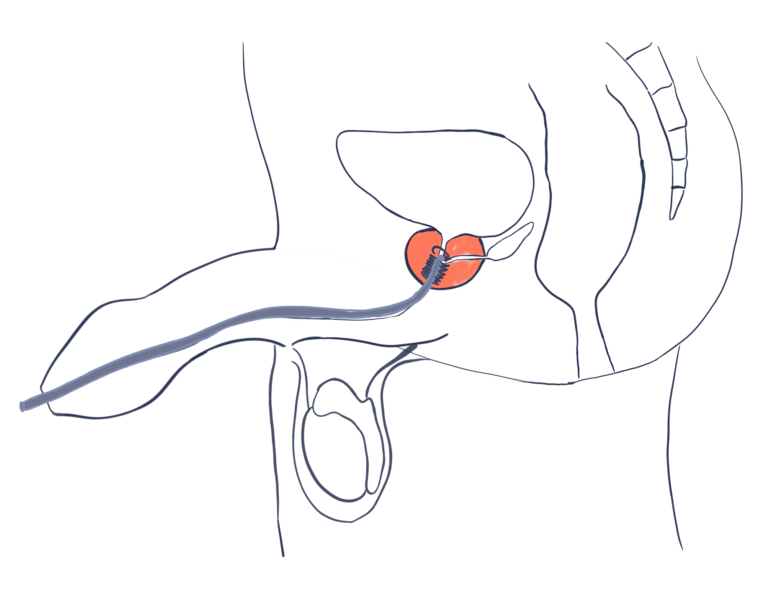 Treatment For Benign Prostatic Hyperplasia