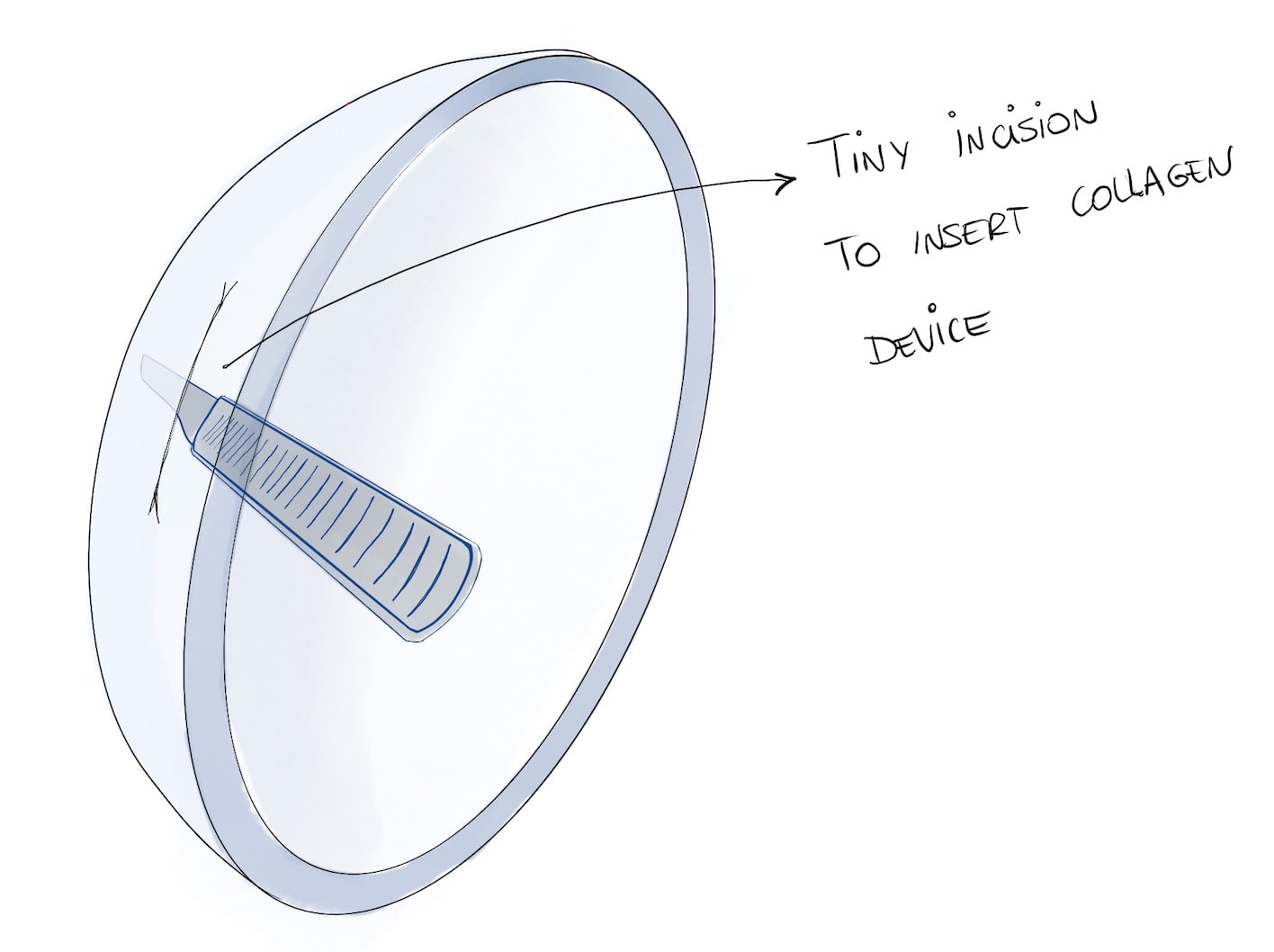 Incision on cornea