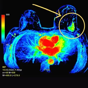 Breast MRI showing breast cancer