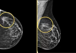 Mammogram showing breast cancer