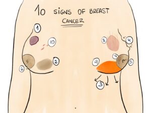 10 signs of breast cancer