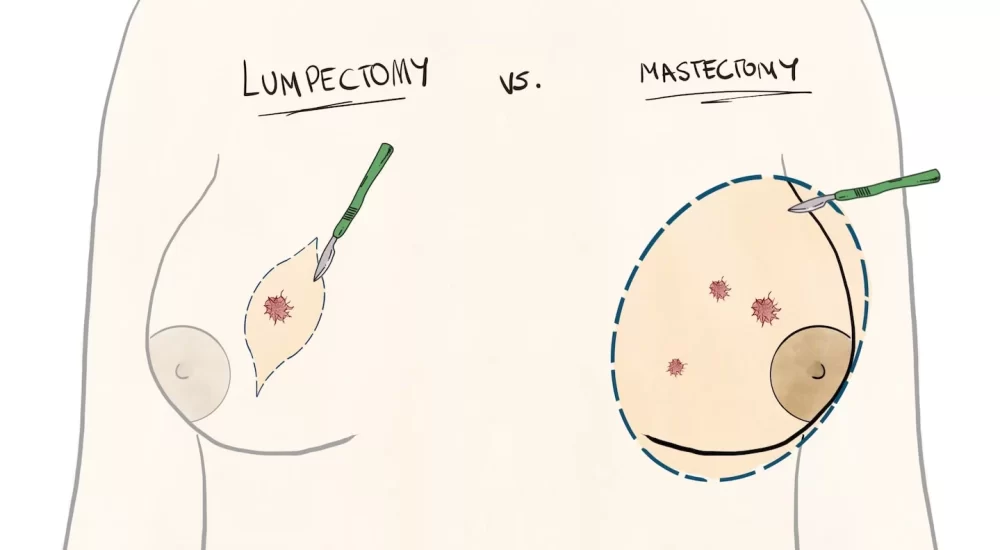 Lumpectomy vs. mastectomy
