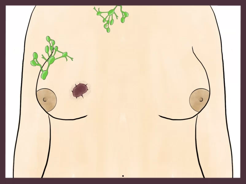 Breast cancer and lymph nodes