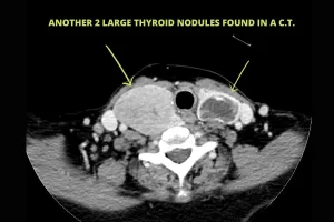 2 large thyroid nodules found in CT scan