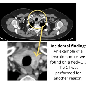 Incidental thyroid nodule found on a CT performed for another reason