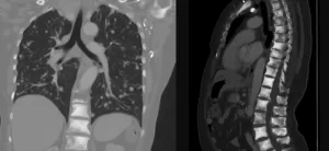 Thyroid cancer metastases in lung and bones