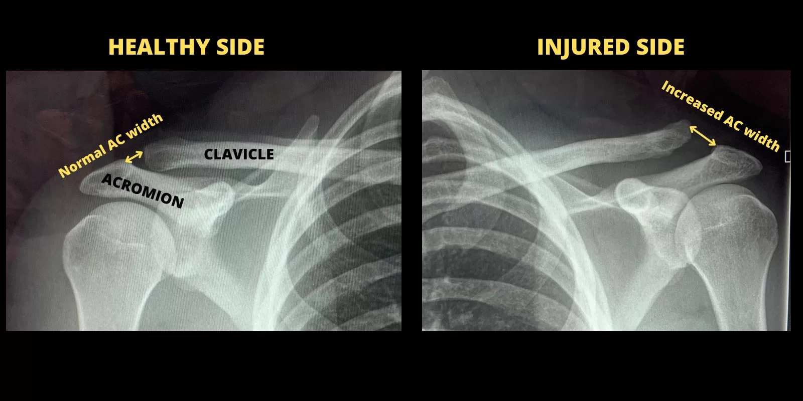 Clavicle x-ray: healthy vs. injured