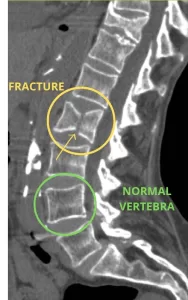 L2 fracture of the spine