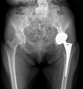 Pelvic x-ray showing a hip replacement on the left