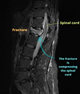 Lumbar fracture MRI